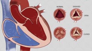 Rheumatic heart disease is a one of type of Heart Disease.